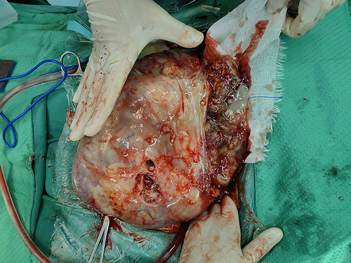 Figure 2 A ruptured 25 cm right ovarian neoplasm was found at the time of surgery.