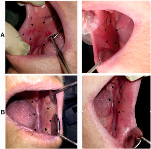 Figure 16. A) Erosive lesion extended in the buccal mucosa of an edentulous patient (right buccal mucosa). This lesion was treated with triamcinolone ointment for two weeks, and the size of the lesion was decreased after treatment. Left: before treatment, the lesion was almost extended throughout the length of buccal mucosa from the commissure of the lips to the ramus. Right: after treatment, the size of the lesion was decreased after receiving the treatment. B) Erosive and reticular lesions of OLP in the left side of the same patient. Right: before treatment, the lesion was extended in the buccal mucosa and the mandibular ridge. Left: after treatment, these lesions were received nanofibrous mats, and after two weeks, the reticular form was almost disappeared, and slight erosion was observed in the distal of buccal mucosa next to the ramus.