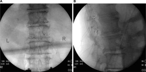 Figure 2 (A) Posterior anterior fluoroscopy image and (B) lateral fluoroscopy image of leads placed bilaterally at T12 and L1 dorsal root ganglions for the treatment of chronic idiopathic orchialgia pain.