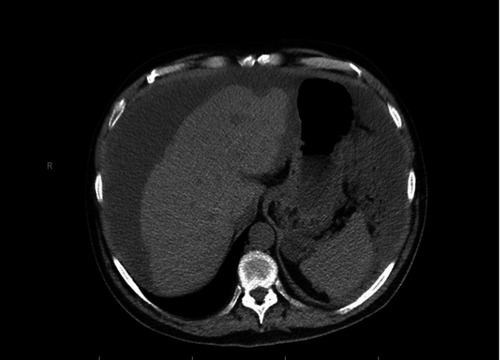 Figure 1 CT scan demonstrating liver scalloping and ascites.