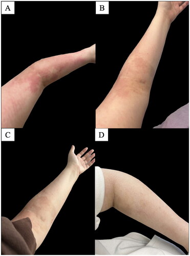 Figure 1. Clinical photos demonstrated resolution of eczematous cirAE throughout treatment with ruxolitinib 1.5% cream on the following days: (A) Day 96; pre-ruxolitinib 1.5% cream, (B) Day 100; day two of ruxolitinib 1.5% cream, (C) Day 104; day six of ruxolitinib 1.5% cream, (D) Day 127; day 29 of ruxolitinib 1.5% cream.