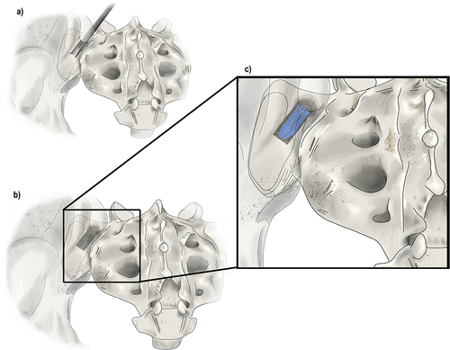 Figure 5 Surgical Techniques: Posterior Allograft Fusion. (a) A large pin (not shown here) is inserted into the joint between the sacrum and the ilium. Next, a tissue dilator and cannula (shown) are inserted to create joint space separation. (b) A rasp is inserted into the cannula to prepare the site for the allograft while decorticating the area. (c) Finally, the allograft which contains the demineralized bone matrix is inserted into the decorticated site to allow for healing and stabilization of the joint. Original medical illustration by Kamil Sochacki, DO.
