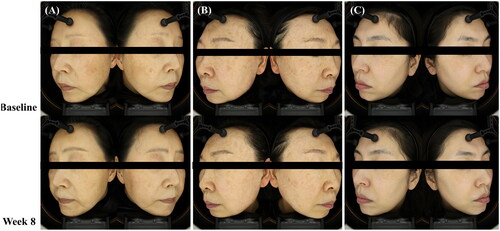 Figure 1. (A, B, C). Clinical photographs of three representative cases showing significant improvements in pigmentary lesions after four treatment sessions with the 785 nm picosecond Nd:YAG laser.
