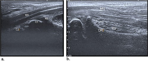 Figure 5 (a) Sagittal US image of the median nerve (MN) in the carpal tunnel. The transducer is parallel to the nerve, and the landmarks are the distal radial epiphysis (RE) and the first (C1) and second (C2) carpal rows. (b) Sagittal US image of the MN in the pronator quadratus (PQ).