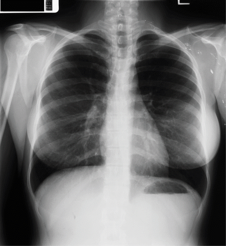 Fig. 1.  Chest radiograph (PA view).