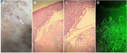 Figure 2. The histopathological findings obtained from this patient. A, B: the vesicular skin lesions exhibited subepidermal blisters containing neutrophils and eosinophils, along with an infiltration of lymphocytes and eosinophils in the superficial dermis (H&E, A: ×200; B: ×400). C, D: the psoriasis lesions are characterized by hyperkeratosis and parakeratosis of the epidermis, clubbing hyperplasia of the epidermis, neutrophil infiltration, thinning of the granular layer, regular thickening of the spinous layer, and a small number of lymphocytes surrounding the blood vessels in the superficial dermis (H&E, C: ×200; D: ×400).