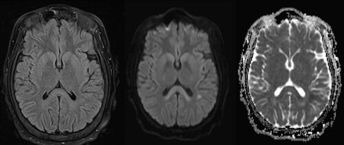 Figure 2. T2W FLAIR, DWI, and ADC sequences, respectively. Abnormal T2 hyperintensity and diffusion restriction involving the splenium of the corpus callosum.