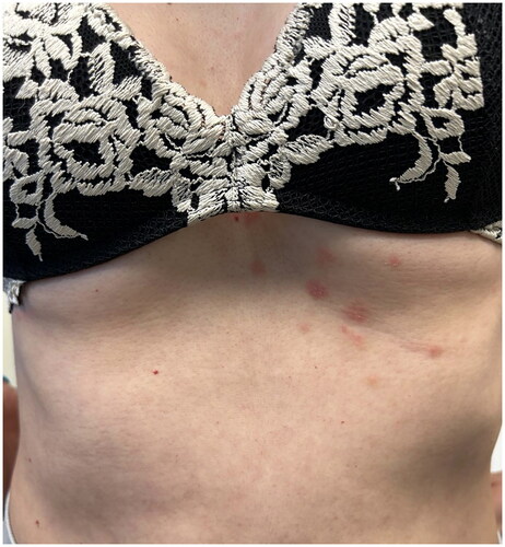 Figure 2. Almost complete remission of pustular psoriasis after 4 weeks of follow-up.