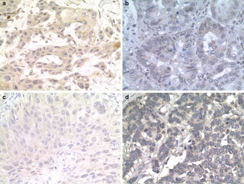 Figure 1. EGFR and LRIG1-3 expressed in tumours of human oesophageal cancer using an immunohistochemical staining procedure. Representative stainings of tumour tissues are shown. a: EGFR, b: LRIG1, c: LRIG2, d: LRIG3. Stainings were visualised at 40×magnification.