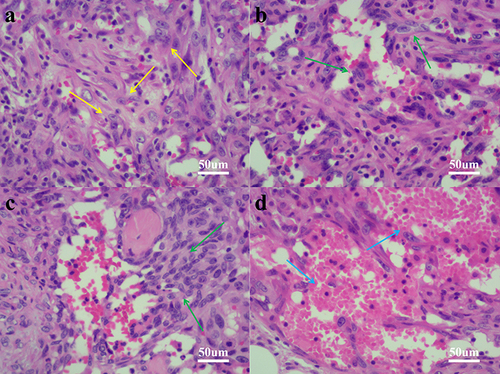 Figure 3 The lesion is located in the empty mesangium, with spindle shaped tumor cells and obvious atypia, indicated by yellow arrows (a). Tumor cells surround irregular blood vessel cavities, with green arrows (b and c). Some areas of the tumor show bleeding foci, indicated by blue arrows (d).