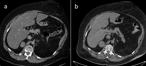 Figure 1 Progression of the adrenal adenoma size during the initial doses of osilodrostat: (a) CT scan directly before osilodrostat therapy – solid nodule 34x24x37 mm, basal density 21 HU; (b) CT scan during treatment with 8 mg of osilodrostat daily – solid nodule 39x36x40 mm, basal density of 27 HU.