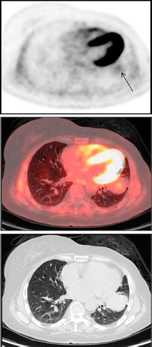 Figure 2. FDG PET (top), PET/CT (middle) and CT (bottom) images showing a very low intensity FDG uptake (arrow) in a large lung mass in the lingula. CT, computed tomography; PET, positron emission tomography.