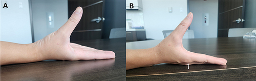 Figure 1 Findings of (A) negative “pronation compensation sign” as the second metacarpophalangeal joint remains in contact with the table while the thumb goes into palmar abduction. (B) positive “pronation compensation sign” as the forearm pronates to compensate for abductor pollicis brevis muscle weakness causing the second metacarpophalangeal joint to lift off the table (indicated by the arrow).