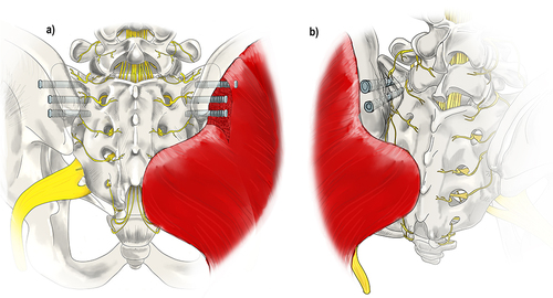 Figure 6 Surgical Techniques: Lateral and Posterior-Oblique Sacral Fusions. (a) The lateral fusion involves the placement of devices across the SIJ from lateral to medial which fixate the ilium and sacrum together. At least two titanium implants are placed through the ilium, or wing bone of the pelvis, across the SIJ, and into the sacrum, the large bone at the base of the spine, to immediately reduce the motion of the joint. This technique involves disruption of musculature. (b) The posterior-oblique approach involves placing implants in a medial to lateral trajectory. The insertion point is the posterior-superior iliac spine which spares dissection of the musculature and minimizes potential injury to other structures. Original medical illustration by Kamil Sochacki, DO.