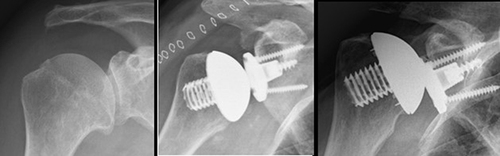 Figure 3 Case example 1: An X-ray series showing preoperative status with osteoarthritis, primary post-operative status with good alignment and space between caput and MB, superior migration indicates PE wear.