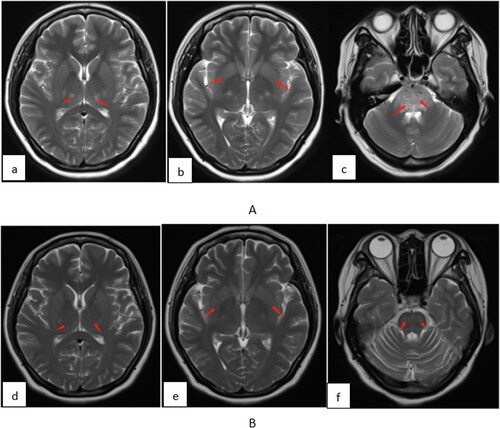 Figure 1. Brain MRI shows signs of toxic encephalopathy (A). Bilateral thalamus, basal ganglia, and brainstem edema almost improved on day 44 (B). thalamus, day 3 (a); basal ganglia, day 3 (b); brainstem edema, day 3 (c); thalamus, day 44 (d); basal ganglia, day 44 (e); brainstem edema, day 44 (f).