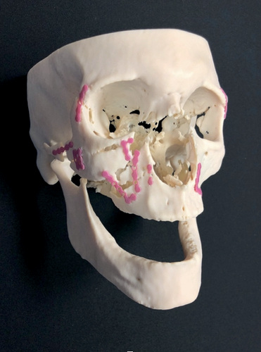 Figure 1. 3D printing model of the skull following first stage open reduction and internal fixation of multiple facial fractures and prior to reconstruction of the naso-orbito-ethmoid complexes.