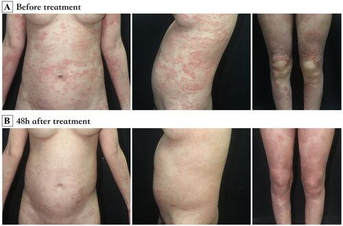 Figure 1. (A) Generalized edematous erythema with numerous pustules over the body. (B) 48h after application of spesolimab, the lesions were significantly improved.