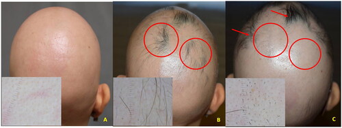 Figure 1. A (baseline): clinical aspect and dermoscopy (insert) of AA universalis; B (three months): regrowth (circles) under baricitinib treatment (4 mg/day); C (five months): relapse within the regrowth areas (circles) while under baricitinib (Phenotype 1); localized new areas of regrowth were observed (arrows).