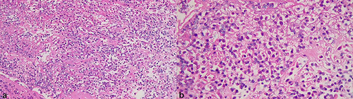 Figure 3 Histopathology of the specimen exhibiting a large number of red blood cells mixed with fibrinous exudate at ×200 magnification (a) and ×400 magnification (b).