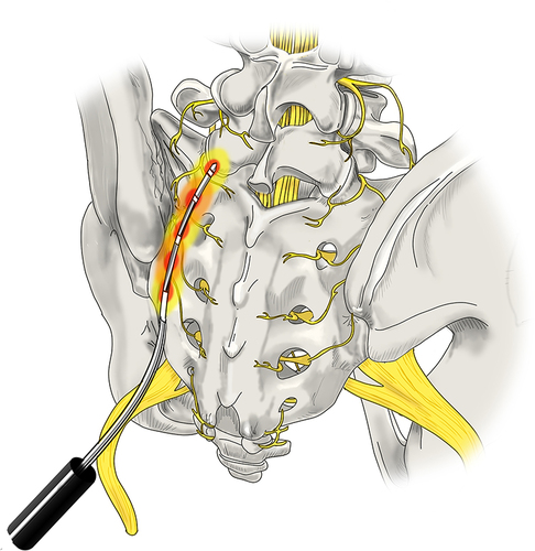 Figure 4 RFA with multilesion probe. This technique utilizes a singular probe which is tunneled through the tissue via a single site to generate a true strip lesion at the SIJ. The probe contains three electrodes creating a combination of monopolar and bipolar lesions. Original medical illustration by Kamil Sochacki, DO.