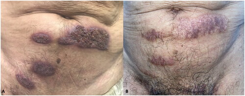 Figure 1. Pyoderma vegetans: initial appearance and 2 months after treatment with doxycycline.
