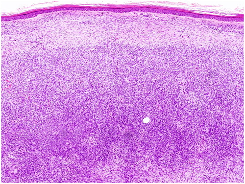 Figure 1. DFSP. Proliferation of uniform spindle cells in the dermis, separated from epidermis by a border zone. (Courtesy: Dr. Daja Šekoranja).