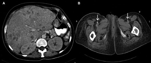 Figure 2. A; Computed tomography shows heterogenous involvement of the liver by the tumor. Enlarged liver compresses the right kidney posteriorly. B; Severe narrowing of the arteries are prominent on the left side. CT images at the level of iliac arteries shows narrowing of the left iliac artery (white arrow) compared to the right iliac artery (white arrow). B. At more caudal level, the left superficial artery is also significantly smaller in diameter due to vasospasm than the right superficial femoral artery (arrows).