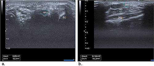 Figure 4 (a) Transverse US image of the median nerve (MN) at the carpal tunnel inlet. The landmarks are the scaphoid (SC) and pisiform (PI). (b) Transverse US image of the MN at the proximal third of the pronator quadratus (PQ).