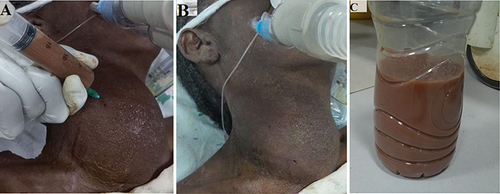 Figure 5 (A) Needle aspiration of thyroid abscess; (B) after draining 450 mL of pus; (C) drained pus.