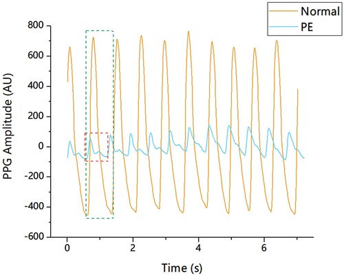 Figure 1. Pulse pattern contrast for preeclamptic and healthy patients. Pulse waveforms from patients with/without PE were drawn in different colours and shapes with magnitudes in arbitrary units (AU). There are obvious differences in amplitude and pulse shape. The notch point is inapparent for the preeclamptic pulse.
