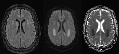 Figure 1. T2W FLAIR, DWI, and ADC sequences, respectively. Abnormal T2 hyperintensity and diffusion restriction involving the bilateral cerebral white matter, including the corona radiata and the centrum semiovale of the frontoparietal lobes.