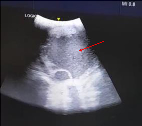 Figure 3 Bedside neck ultrasound of the patient showing hypoechoic lesion in the right lobe of the thyroid gland as depicted by the arrow.
