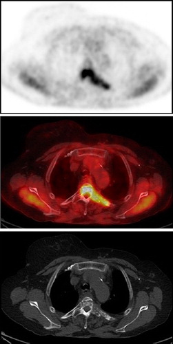 Figure 1. FDG PET (top), PET/CT (middle) and CT (bottom) images showing a high intensity FDG uptake in a lytic-sclerotic lesion involving the body and left transverse process of T4 vertebra and the left costovertebral aspect of the adjacent 4th rib. CT, computed tomography; PET, positron emission tomography.