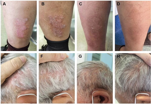 Figure 3. A, E: The occurrence of psoriatic lesions was observed subsequent to the administration of dupilumab for a period of two weeks (PASI = 1.6). B, F: the lesions associated with psoriasis became more severe subsequent to the implementation of a dupilumab treatment regimen lasting six weeks (PASI = 2.4). C, G: following a 4-week course of treatment consisting exclusively of upadacitinib, a significant improvement in cutaneous lesions was observed, with no occurrence of new lesions (PASI = 0.8). D, H: Existing lesions continued to diminish and no new lesions were observed following a sustained 10-week course of upadacitinib treatment (PASI = 0).