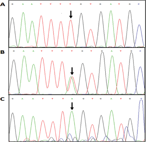 Figure 2. Sequencing result for FTO rs9939609 polymorphism. (a) TT genotype; (b) AT genotype; (c) AA genotype.