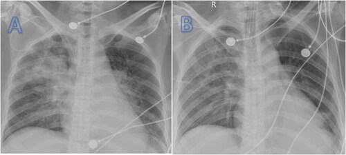 Figure 2. Chest radiography showed pulmonary edema and right upper lobe infiltrate on admission (A). Repeat chest radiography showed reduced pulmonary edema and resolved infiltrate on day 7 (B).