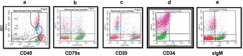 Figure 4. Mature B-ALL. The blasts were gated and colored green. (a) dot plot of CD45 versus SSC by which leukemic cells are selected. (b) the plot shows the expression of CD79a on blast cells. (c) dot plot of CD20 versus SSC. (d) dot plot shows the absence of CD34 expression. (e) dot plot of IgM versus SSC with the positive expression of IgM.