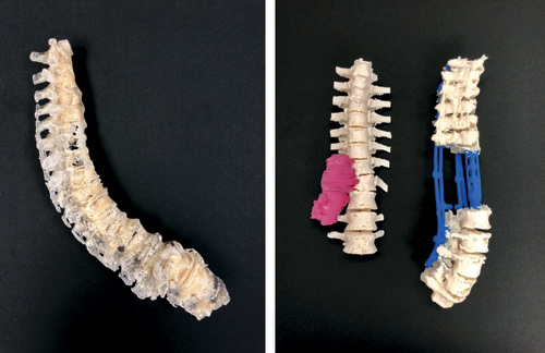 Figure 2. 3D printing models of a degenerative spine (left) and in preparation for spinal reconstruction associated with tumor extirpation (right).