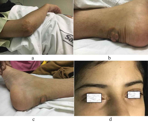 Figure 1. A. Xanthomas on elbow. B, C. Achilles tendon xanthomas on the heel. D. Xanthelasma palpebrum.