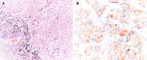 Figure 1. A; Neuroendocrine tumor composed of monotonous cells with oval nuclei and visible cytoplasms in metastatic nests in a lymph node (HE, ×100). B; Positive immunohistochemical staining with synaptophysine (synaptophysine, ×400).