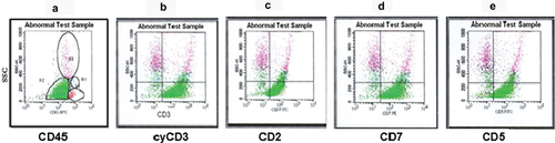 Figure 5. Shown are representative dot plots for the expression of surface and intracellular antigens of T-ALL leukemic cells. (a) CD45 versus SSC with a high percentage of blasts (green). Strong expression of cyCD3 (b), CD2 (c), CD7 (d) and CD5 (e) on the blast cells (green).
