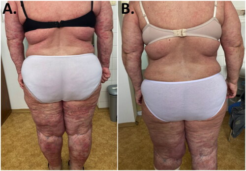 Figure 1. (A) Patient with GPP treated by systemic corticosteroids. (B) Patient with GPP after 12 weeks of guselkumab treatment.