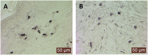 Figure 1. Immunohistochemical staining for (A) mast cell tryptase and (B) IgE on skin sections from the forearm sun-exposed skin. Note that there are several IgE+ cells with cell membrane-like circular staining (B). The micrographs were taken using a 40× objective.
