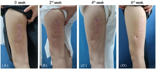 Figure 1. A 29-year-old female presented with annular erythema with mild annular induration on the left lower extremity before abrocitinib treatment (A), and progressive thinning of the plaques two, four weeks after abrocitinib treatment (B, C) and near complete clearance of lesions following six weeks of abrocitinib treatment (D).