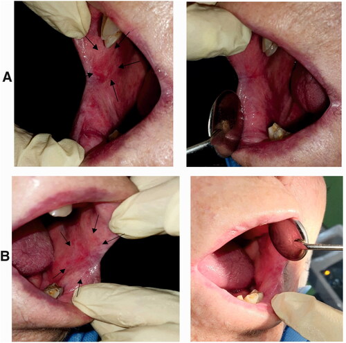 Figure 15. A) Erosive OLP lesions in a patient (right buccal mucosa) treated with Triamcinolone ointment. Left: before treatment, an oval shape erosion was obvious in the buccal mucosa next to the commissure of the lips. Right: after treatment. The erosive lesion was completely removed, and the healthy mucosa was regenerated. B) Erosive and reticular OLP lesions in the same patient (left buccal mucosa) treated with nanofibrous mats. Left: before treatment, an oval shape erosion with white lace-like reticular lines was obvious in the buccal mucosa next to the commissure of the lips. Right: after treatment. The erosive lesion and most of the white reticular lines were removed.