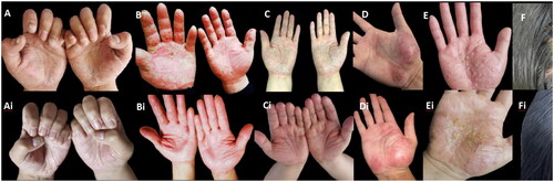 Figure 1. (A–G) The paradoxical skin lesions of the 7 cases with SAPHO syndrome treated with IL-17A inhibitors. (Ai) After discontinuing IL-17A inhibitors and adding tofacitinib for 10 weeks, the paradoxical skin lesions has improved. (Bi) After discontinuing IL-17A inhibitors and adding tofacitinib for 2 weeks, the paradoxical skin lesions has improved. (Ci) After discontinuing IL-17A inhibitors and adding tofacitinib for 2 weeks, the paradoxical skin lesions has improved. (Di) After discontinuing IL-17A inhibitors and adding tofacitinib for 12 weeks, the paradoxical skin lesions has improved. (Ei) After discontinuing IL-17A inhibitors and adding tofacitinib for 8 weeks, the paradoxical skin lesions has improved. (Fi) After discontinuing IL-17A inhibitors and adding tofacitinib for 5 weeks, the paradoxical skin lesions has improved. (Gi) After discontinuing IL-17A inhibitors and adding tofacitinib for 6 weeks, the paradoxical skin lesions has improved.