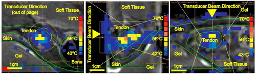 Figure 3. T2-weighted MRI image of the Achilles tendon with MR thermometry (PRFS-MRT) at the end of the MRgFUS thermal ablation sonication showing the maximum temperature achieved for Group 2B (pulsed FUS and 900 J). Temperature mapping corresponds to the scale (blue = 40°, yellow = 55°, red = 70°) displayed on the right for PRFS-MRT in (a) sagittal, (b) axial, and (c) coronal views. The white lines represent the sonication cone; the yellow lines represent the treatable sonication region.