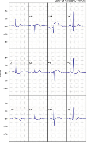 Figure 5 Reconstructed 12-lead electrocardiogram demonstrating an ST-elevation myocardial infarction.