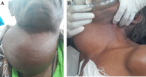 Figure 1 Anterior (A) and lateral (B) neck view of the patient with thyroid gland abscess.
